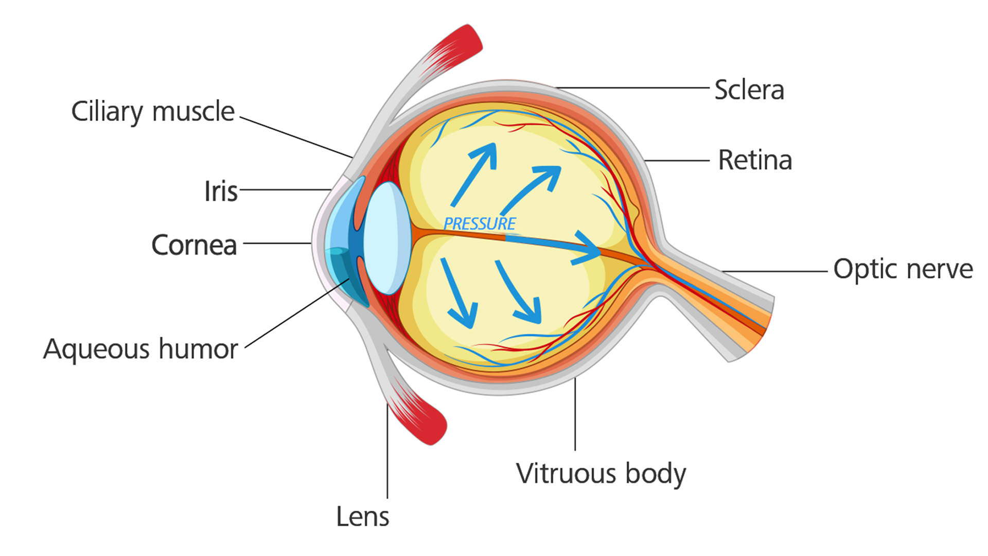 Glaucomás szem: A szemnyomás emelkedik, és kárt tesz a látóidegben.